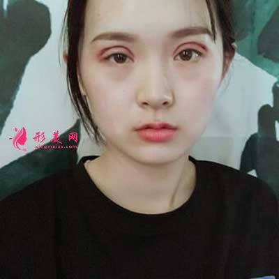 分享我去佛山華美找梁宗建院長做全切雙眼皮手術(shù)后
