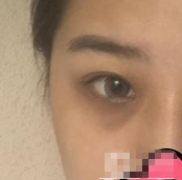 沈陽杏林整形醫(yī)院割雙眼皮效果咋樣?真人案例反饋