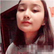 長沙愛思特胡朝輝磨骨手術(shù)做的怎么樣？附磨骨前后對(duì)比圖