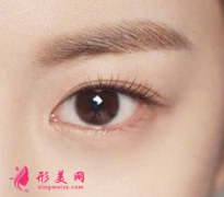 開眼角術(shù)后會回縮嗎？