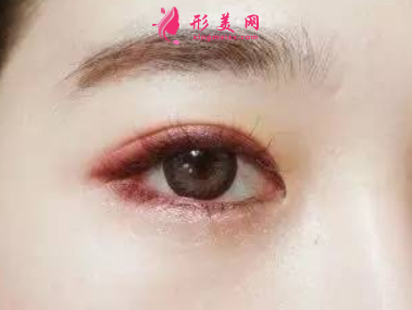 開內(nèi)眼角疤痕增生能消下去嗎