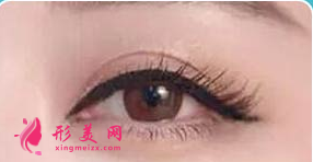 開眼角以后還會變小嗎