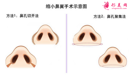 鼻翼縮小術(shù)后痛不痛