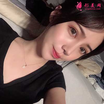 消失空白的寬鼻矯正術(shù)后76天照