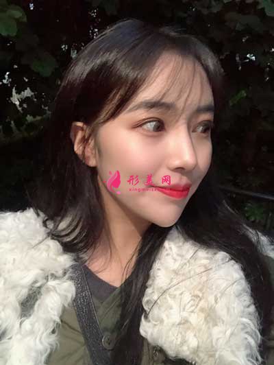 消失空白的寬鼻矯正術(shù)后41天照