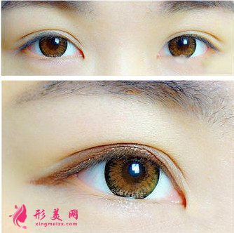 長(zhǎng)沙伊百麗雙眼皮修復(fù)效果好嗎