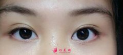 雙眼皮手術后腫脹大概在幾天？