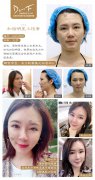 馮斌解答-自體脂肪與玻尿酸有什么區(qū)別？