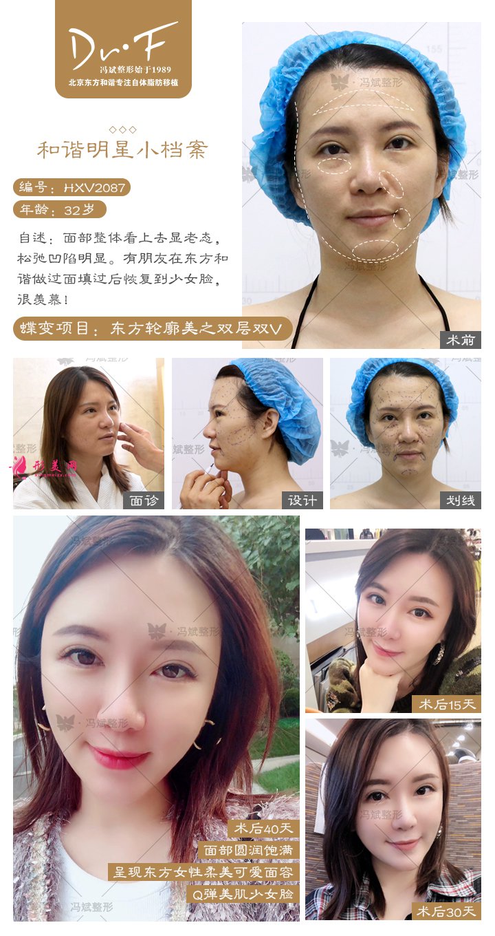 自體脂肪移植