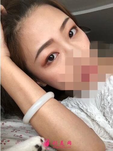 2020！深圳名媛匯整形醫(yī)療美容價格表，外切去眼袋體驗(yàn)分享