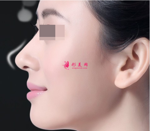 軟骨隆鼻費(fèi)用貴嗎