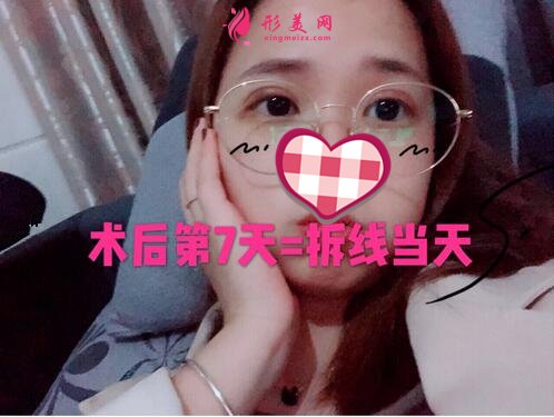 深圳米蘭柏羽做眼睛多少錢