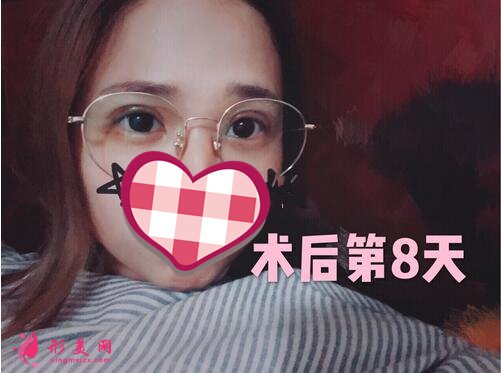深圳米蘭柏羽做眼睛技術(shù)好不好 雙眼皮案例