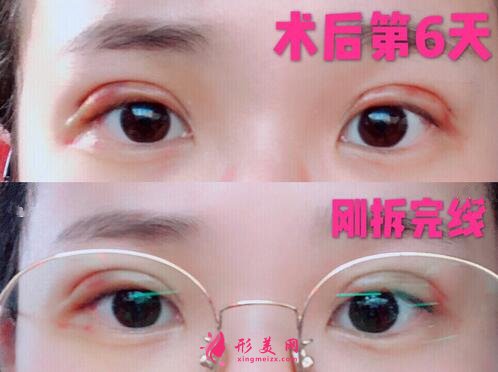 深圳米蘭柏羽做眼睛怎么樣？這個(gè)案例圖告訴你答案