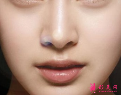 隆鼻大約要多少錢(qián)
