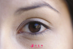 開眼角術(shù)后要怎樣恢復(fù)得更好？