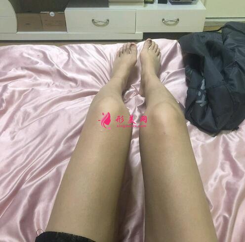 深圳顏美醫(yī)療美容醫(yī)院吸脂案例，打造纖細(xì)大腿
