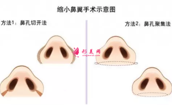 鼻翼縮小手術(shù)后可以化妝嗎