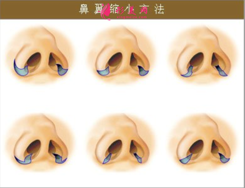 鼻翼縮小手術(shù)后會(huì)有腫脹嗎