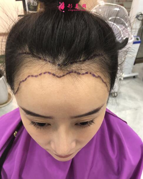 女性毛發(fā)種植術(shù)后98天效果反饋，很驚人就對了！