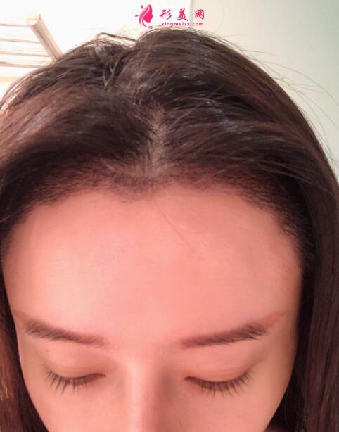 女性毛發(fā)種植術(shù)后98天效果反饋，很驚人就對了！
