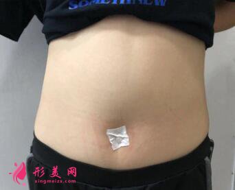 360吸脂案例對比，成功瘦身成為大美女啦！