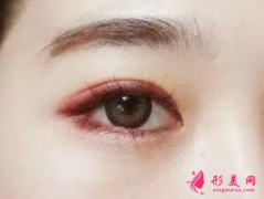 內(nèi)眼角修復(fù)會越修越難看嗎？