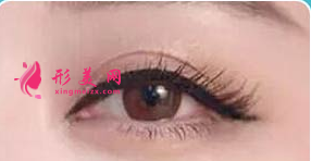 內(nèi)眼角修復(fù)會越修越難看嗎