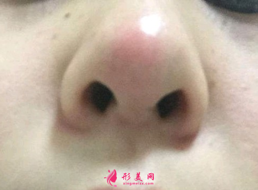 廣州隆鼻失敗修復(fù)手術(shù)要多少錢
