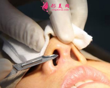 廣州隆鼻失敗修復(fù)手術(shù)要多少錢