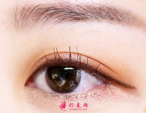 廣州開(kāi)內(nèi)眼角多少錢(qián)