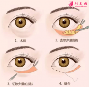 手術(shù)祛眼袋的過程痛不痛?