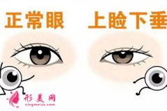 上瞼下垂矯正術(shù)怎么樣？矯正容貌美麗一生