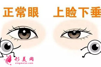 上瞼下垂矯正術(shù)怎么樣？矯正容貌美麗一生