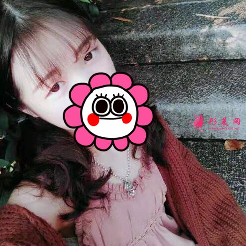 石家莊美聯(lián)臣怎么樣？雙眼皮案例