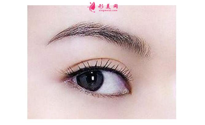 割雙眼皮開眼角價(jià)格