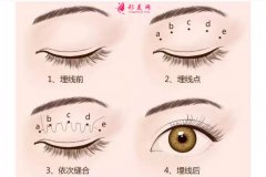 割雙眼皮開眼角價(jià)格是多少？影響價(jià)格的原因是什么？