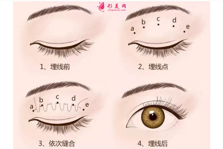 割雙眼皮開眼角價(jià)格