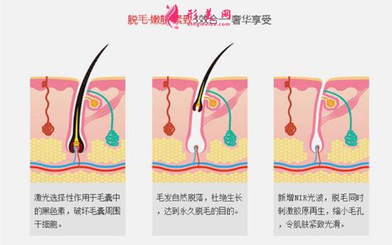 大腿永久脫毛多少錢