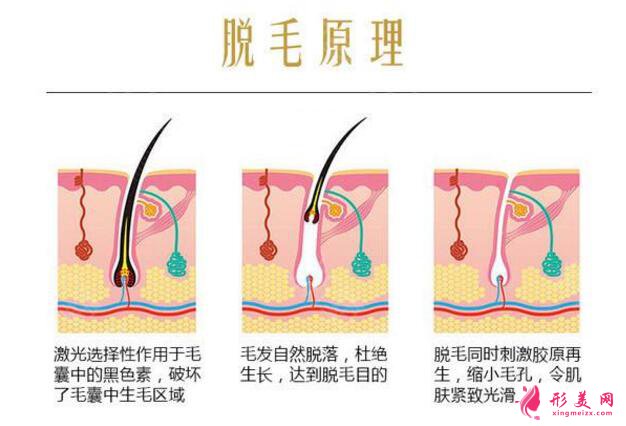 大腿永久脫毛多少錢