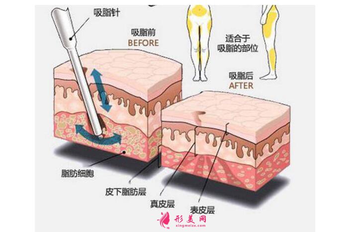 胳膊吸脂價(jià)格