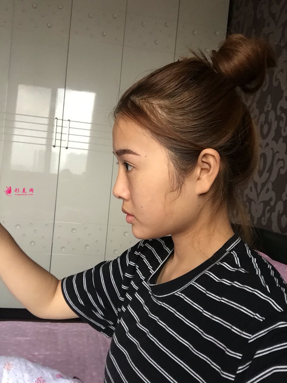 【效果圖】玻尿酸豐唇整形術(shù)后照片，這個(gè)嘟嘟唇真好看~