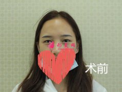 深圳赫思醫(yī)療美容怎么樣？價目表及網(wǎng)紅鼻整形案例
