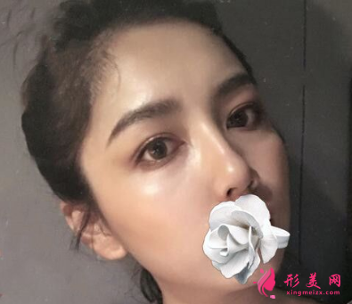 武漢同濟(jì)整形王海平隆鼻怎么樣？前后60天對比圖 案例分享