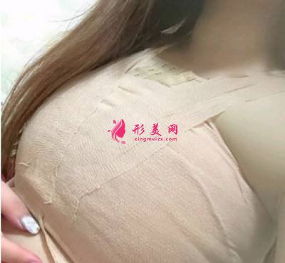 北京美萊王志強院長為我做自體脂肪隆胸手術(shù)后10天