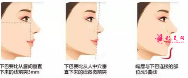 自體脂肪隆下巴效果圖