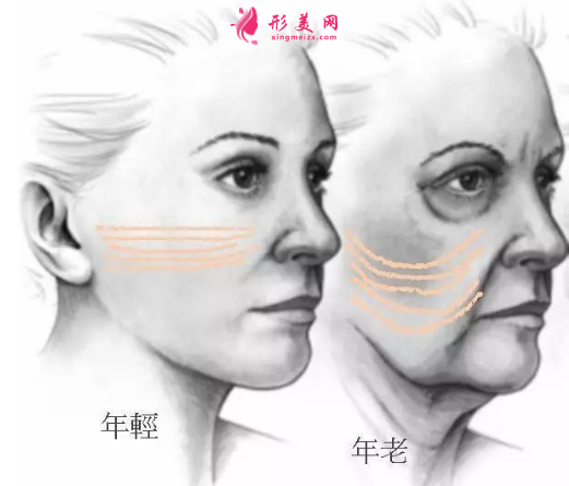 埋線面部提升