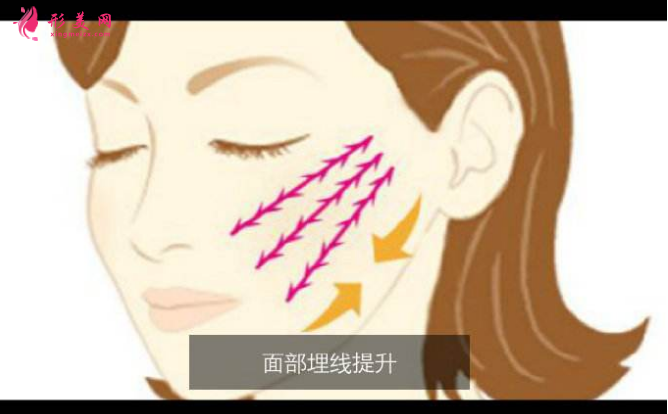 埋線面部提升