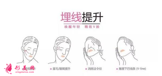 埋線面部提升