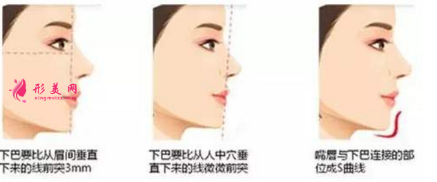 自體脂肪隆下巴效果圖